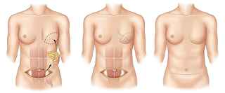 Different Types Of Breast Reconstruction Surgery