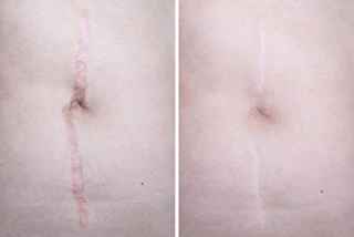 Scar removal in Abu Dhabi