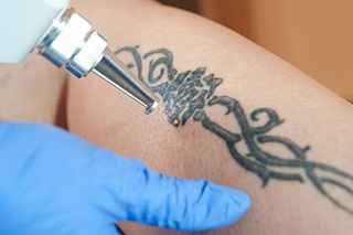 Understanding Tattoo Removal Paper Effectiveness in Riyadh