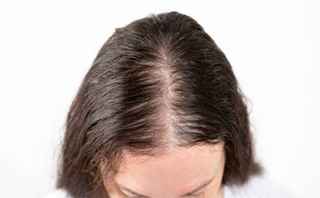 Alopecia Areata Treatment in Abu Dhabi