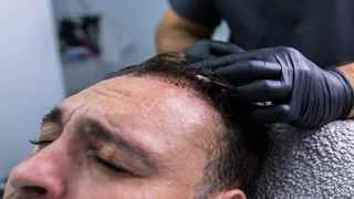 PRP Hair Treatment in Abu Dhabi.
