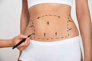Tummy Tuck in Dubai