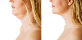 Mesotherapy for intimate area in Abu Dhabi