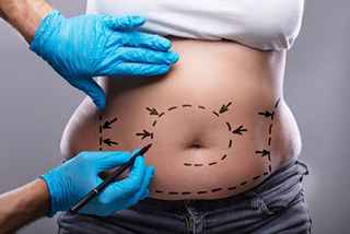 Mini gastric bypass in Abu Dhabi