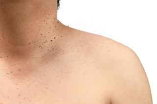 Seborrheic Keratosis Treatment in Abu Dhabi
