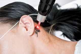 Laser Pigmentation Treatment costs in Abu Dhabi