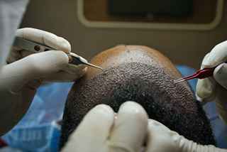 Hair Replacement in Abu Dhabi