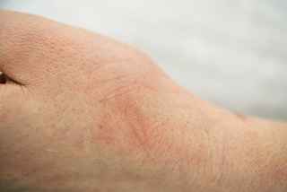 Stretch marks Removal in Abu Dhabi