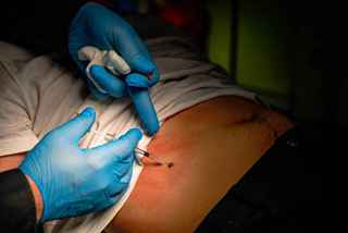 Skin Warts Removal Clinic in Abu Dhabi