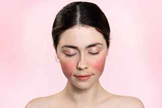 Rosacea Treatment in Abu Dhabi