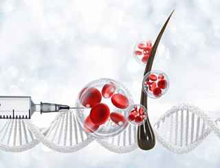 Stem Cell Hair Transplant in Abu Dhabi