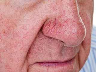 Spider Veins Treatment in Abu Dhabi