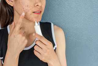 acne treatment in Abu Dhabi