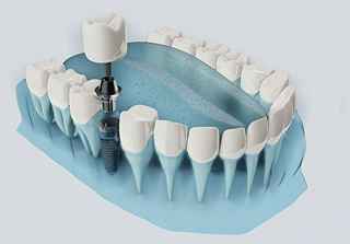 Best Teeth Implants in Dubai