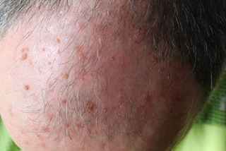 Actinic Keratosis treatment in Abu Dhabi