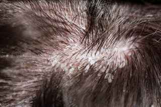 Fuss Hair Transplant in Abu Dhabi