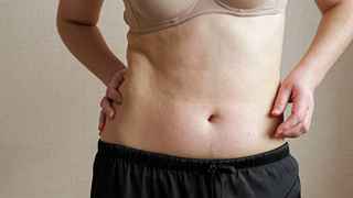 High-definition liposculpture in Abu Dhabi