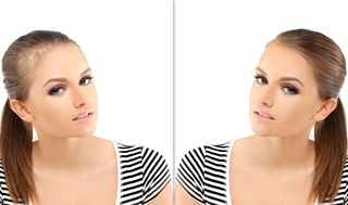 Female Hair Transplant in Abu Dhabi