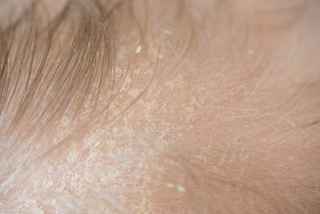 Actinic Keratosis treatment in Abu Dhabi