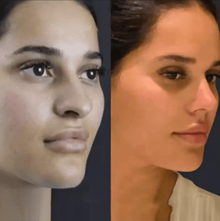 Dubai Rhinoplasty: Nasal Symmetry
