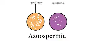 Azoospermia