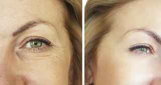 How to Choose the Right Blepharoplasty for Your Skin Type
