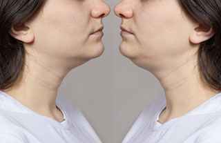 Chin Augmentation in Abu Dhabi