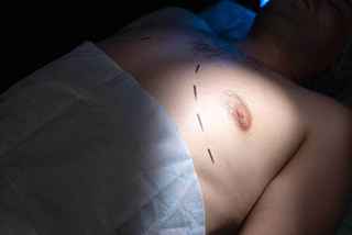 Gynecomastia Surgery Abu Dhabi