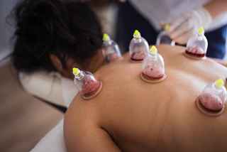 Cupping Treatment in Riyadh: Your Path to Natural Healing