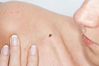 Get Informed: Dermoscopy Mole Evaluation Demystified