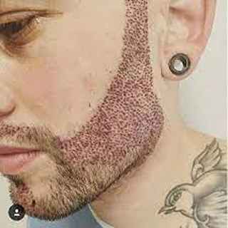 Exploring the Science Behind Beard Hair Transplants