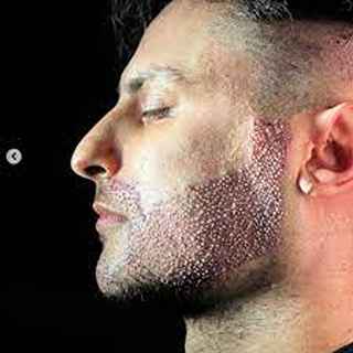 Exploring the Science Behind Beard Hair Transplants