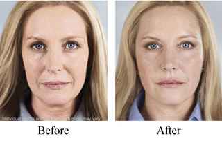Sculptra treatment