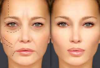 Get the Eyes You Desire: Eyelid Surgery in Riyadh