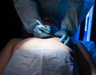 Common Myths About Gynecomastia Surgery Debunked