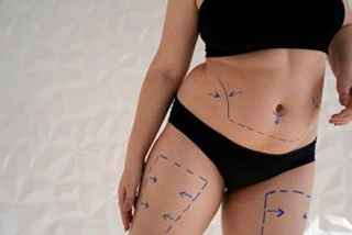 Common Myths About Stretch Marks Removal Debunked
