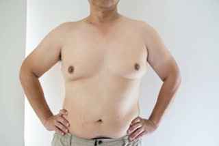 How to Prepare for Gynecomastia Surgery