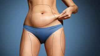Liposuction surgery in Dubai