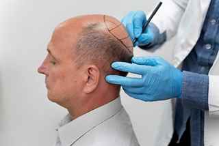 Scalp Micropigmentation What You Need to Know