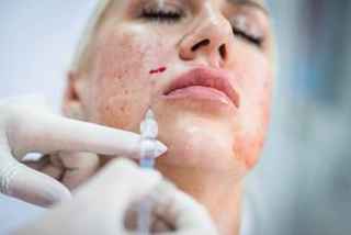 The Impact of Skin Booster Injections