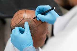 The Incredible Impact of a Crown Hair Transplant 
