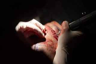 When Is Stem Cell Therapy Available?