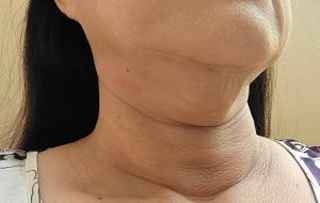 Who Can Benefit from Double Chin Removal?