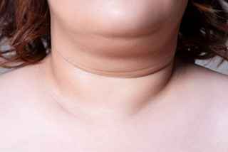 Who Can Benefit from Double Chin Removal?