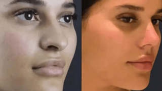 Is Rhinoplasty Surgery in Dubai Right for You?