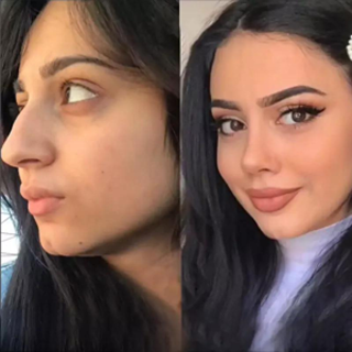 Rhinoplasty Dubai