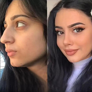 The Ultimate Guide to Finding the Best Rhinoplasty Surgeons in Dubai