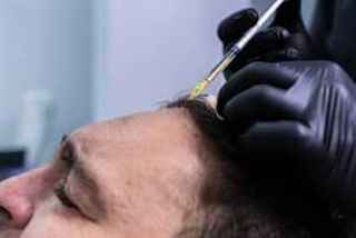 The Pros and Cons of PRP Hair Treatment