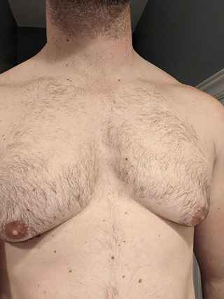 Who is an Ideal Candidate for Gynecomastia Surgery?