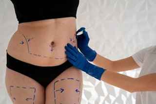 Expert Recommendations for Body Fillers and Butt Fillers